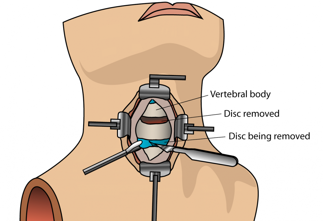 Anterior Cervical Discectomy & Fusion (ACDF) Surgery