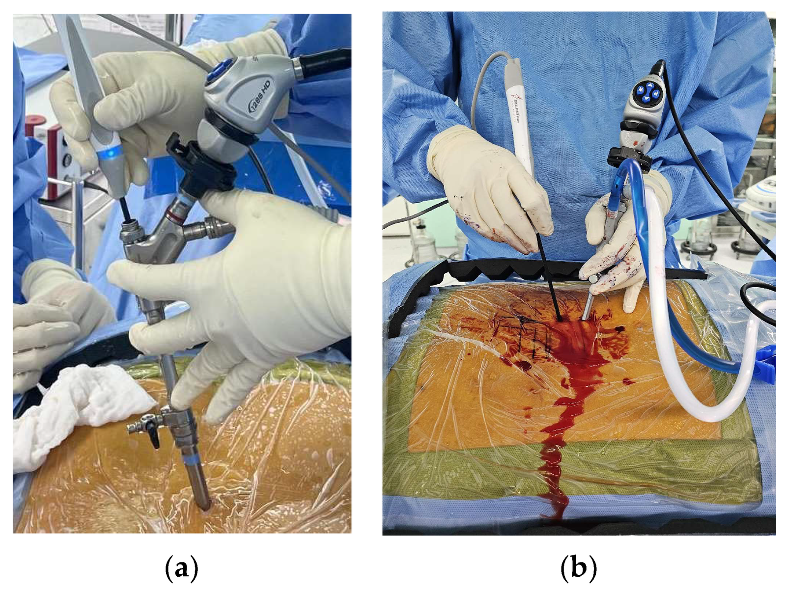 Endoscopic Spine Surgery