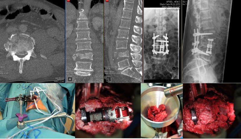 Fracture Spine Surgery In Pune