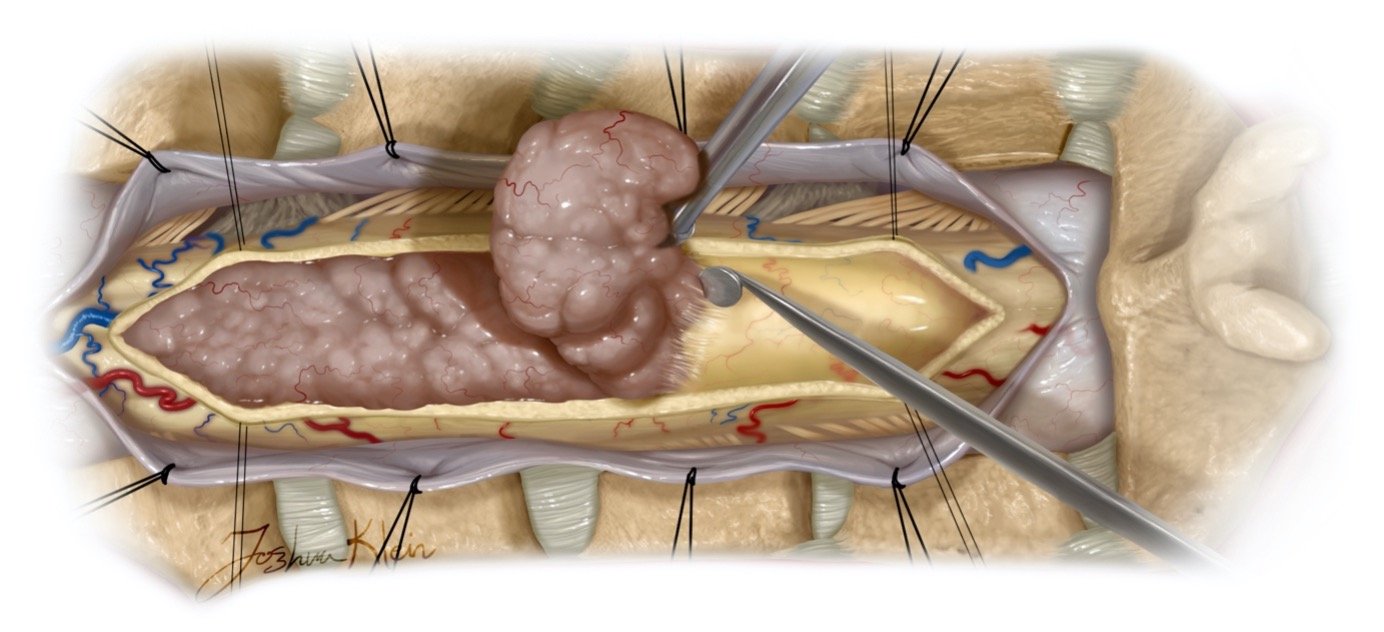 Spine Tumor Surgery