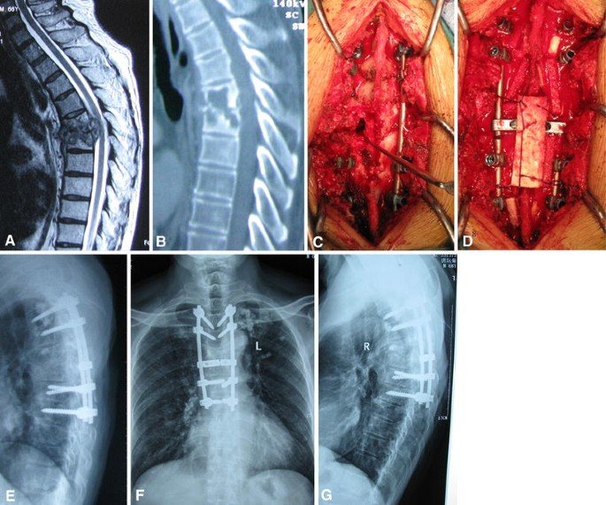 Tuberculosis Spine Surgery