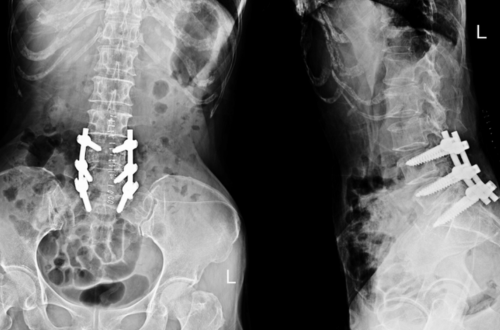 Lumbar Spinal Fusion