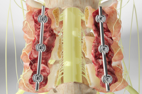 Posterior Cervical Spine Surgery