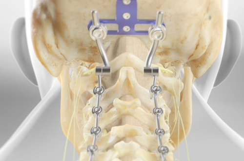 occipitocervical fusion